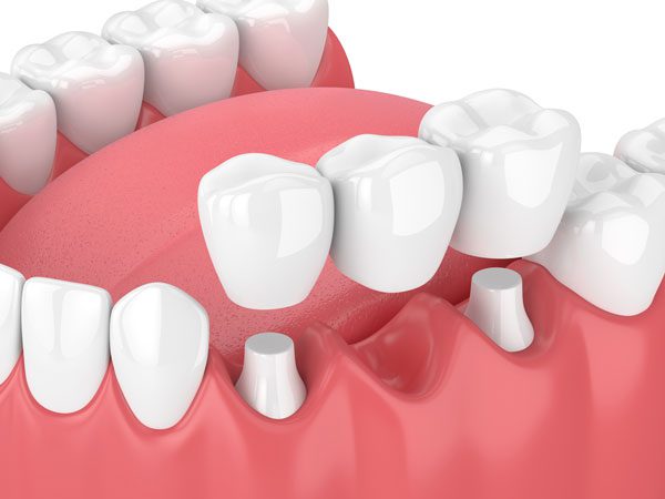 انواع روکش دندان