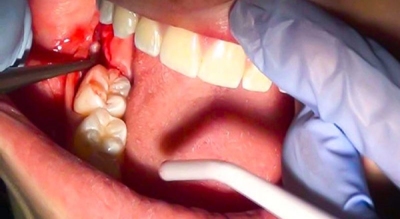 کشیدن دندان