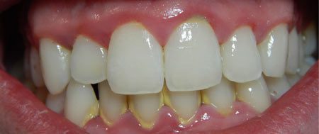 پلاک و حساسیت دندان