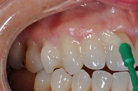 فلوراید ضد حساسیت دندان
