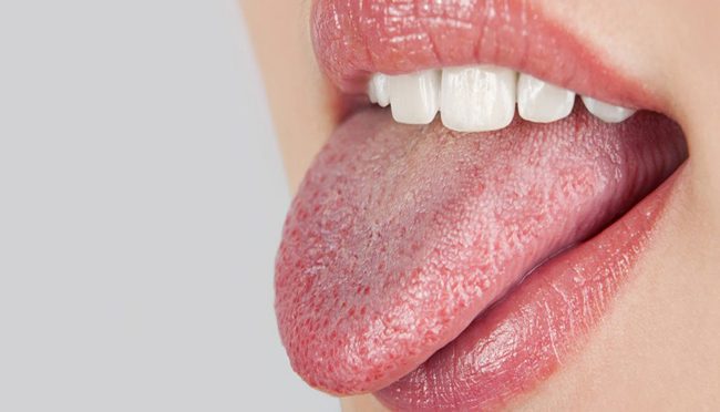 خشکی دهان و زبان:علت، علائم و درمان - کلینیک دندانپزشکی ویستا